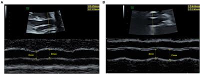 Aortic Elasticity and Cardiac Function in Fetuses With Aortic Coarctation